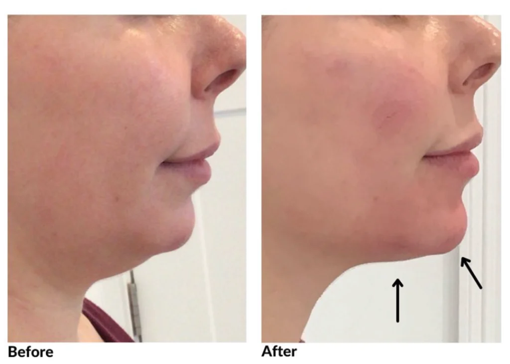 Before and after images show chin enhancement using fillers for a more defined jawline.
