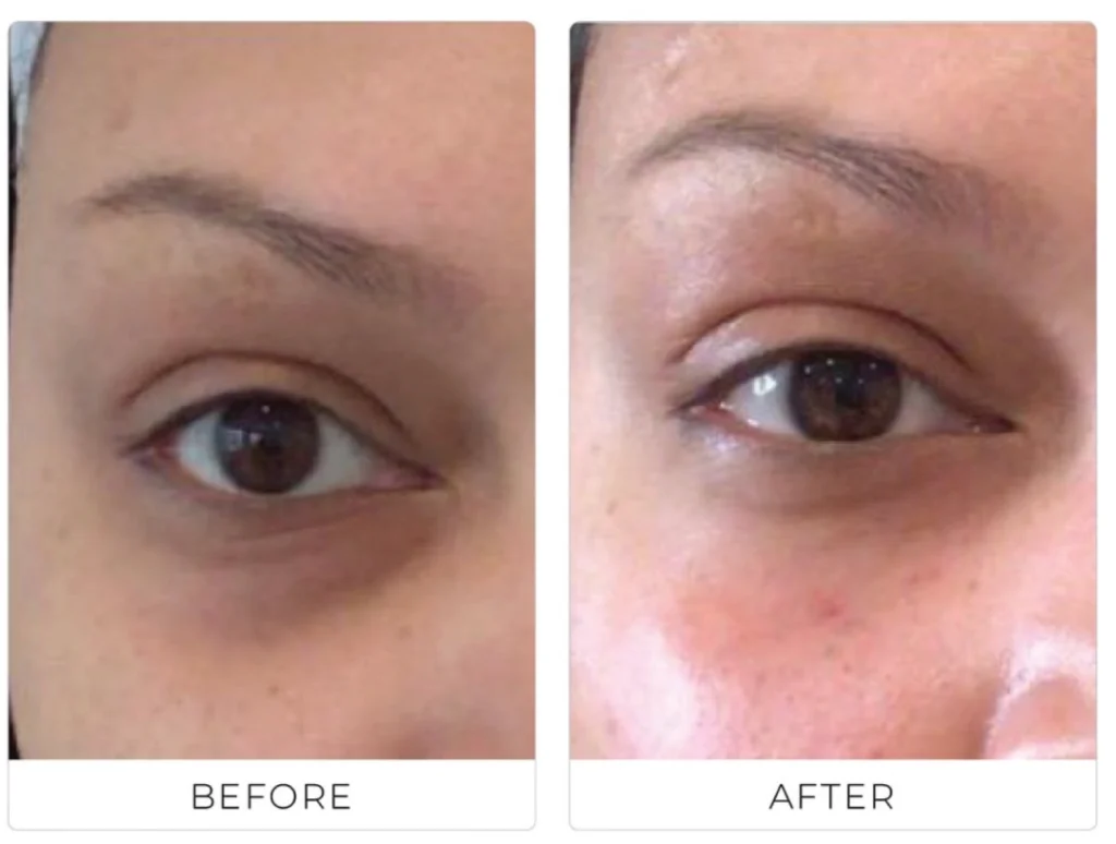 Close-up before and after of under-eye filler used to reduce dark circles and hollowness.