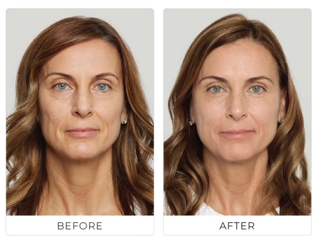 Sculptra before and after photos of a middle-aged woman with more lifted, youthful facial appearance.