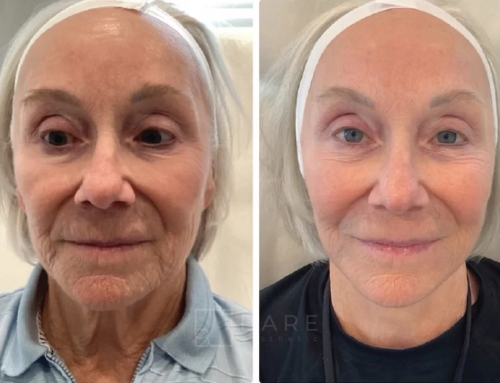 Before and after images showing Sculptra results on an older woman's face with smoother skin.
