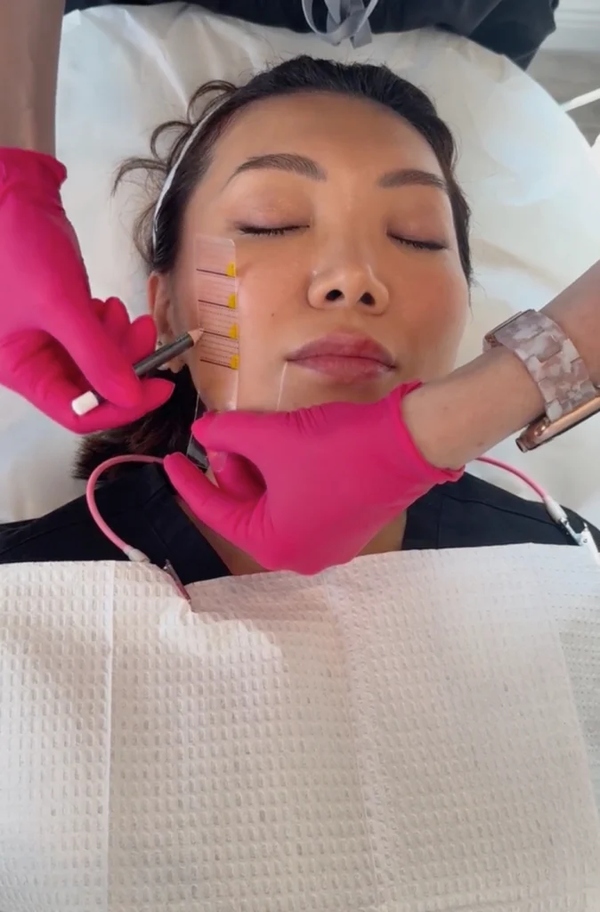 Ultherapy technician marks treatment zones on a patient’s face with a transparent grid tool.