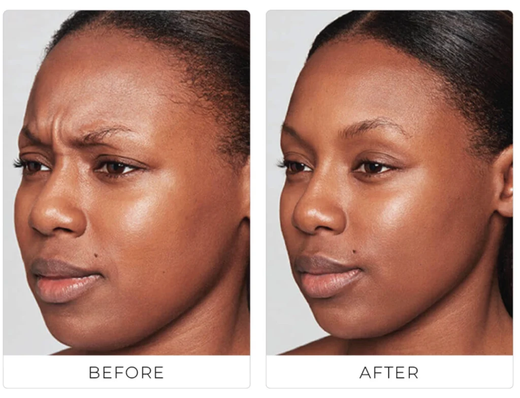 Wrinkle relaxers before and after results showing reduced forehead lines and a smoother brow on a woman’s face.