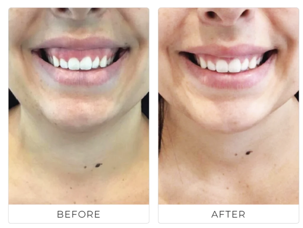 Before and after of wrinkle relaxers used to treat a gummy smile, showing a more balanced and natural lip appearance.