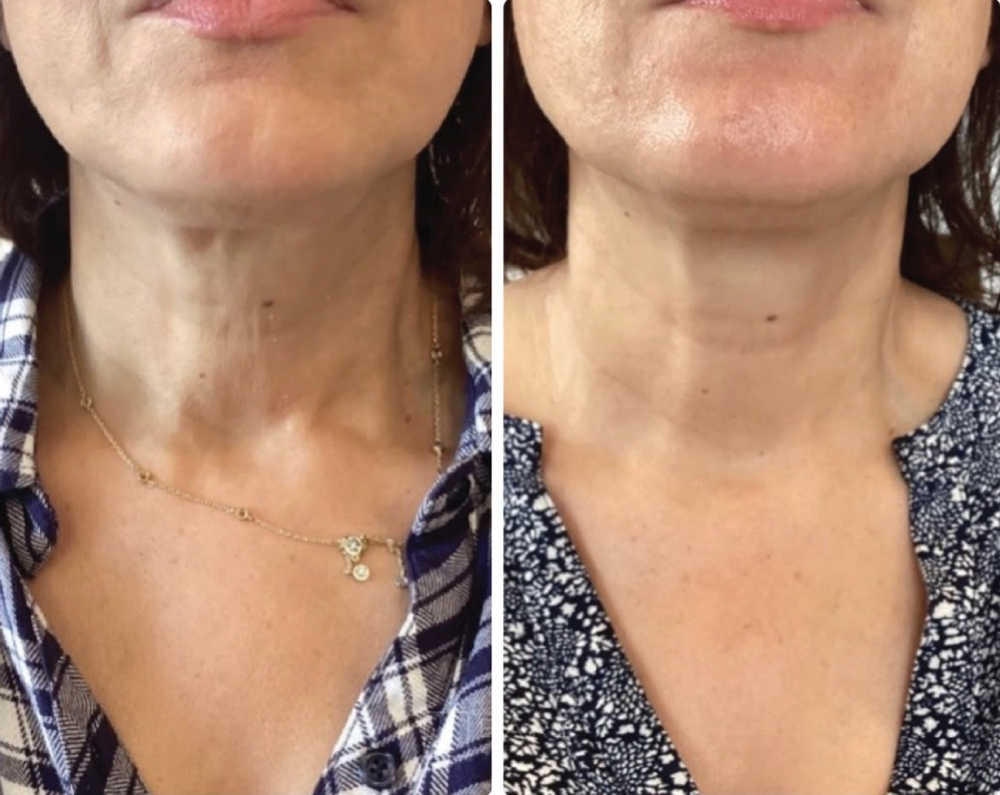 Morphus8 RF microneedling neck before and after